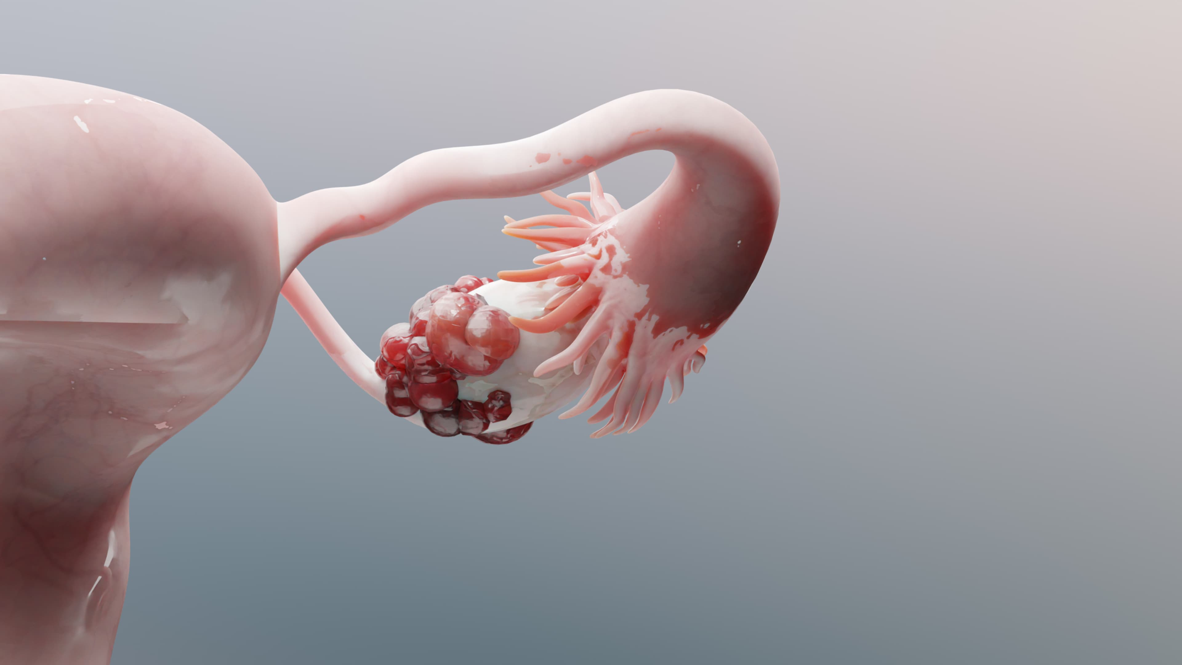 Ovarian Cancer